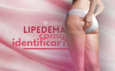 Lipedema: Como Identificar?