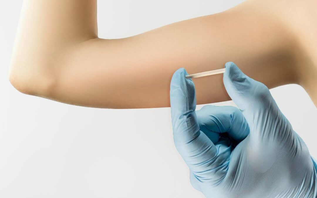 Qual o Valor Médio de um Implante Hormonal?