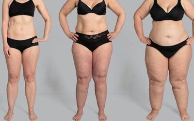 Qual o Melhor Remédio Natural para o Lipedema?