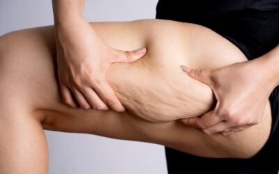 Lipedema: O que é, Sintomas, Causas e Tratamento