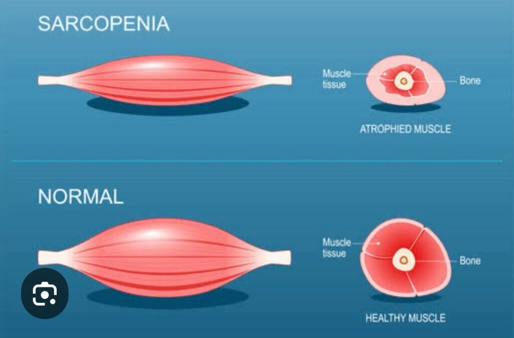 O que provoca sarcopenia?