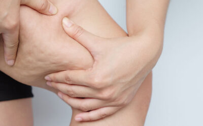 Qual o Melhor Tratamento para Celulite e Flacidez nas Coxas?