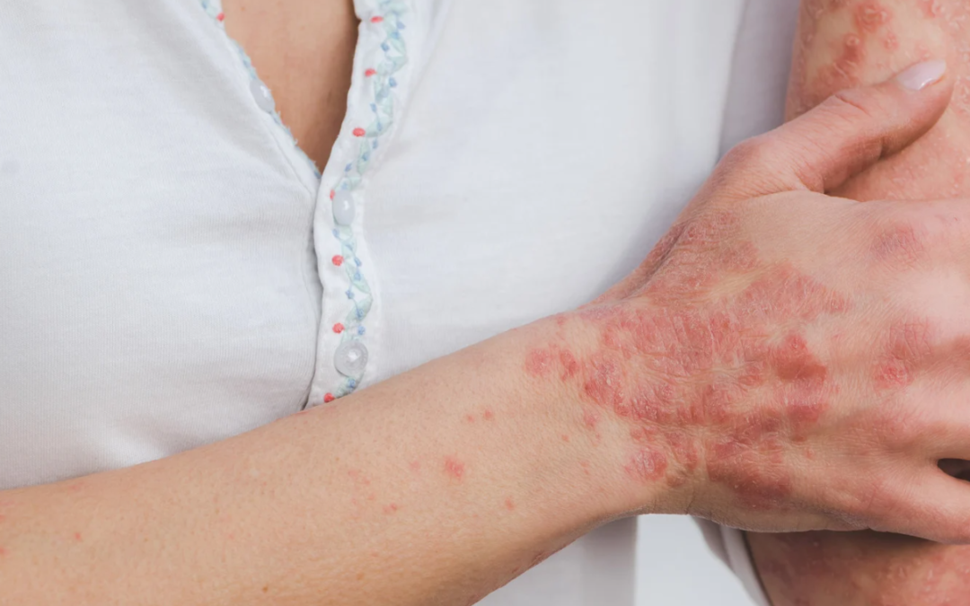 Quais São as 5 Doenças Autoimunes Mais Comuns?